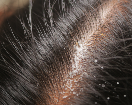 Dandruff & Scalp Care