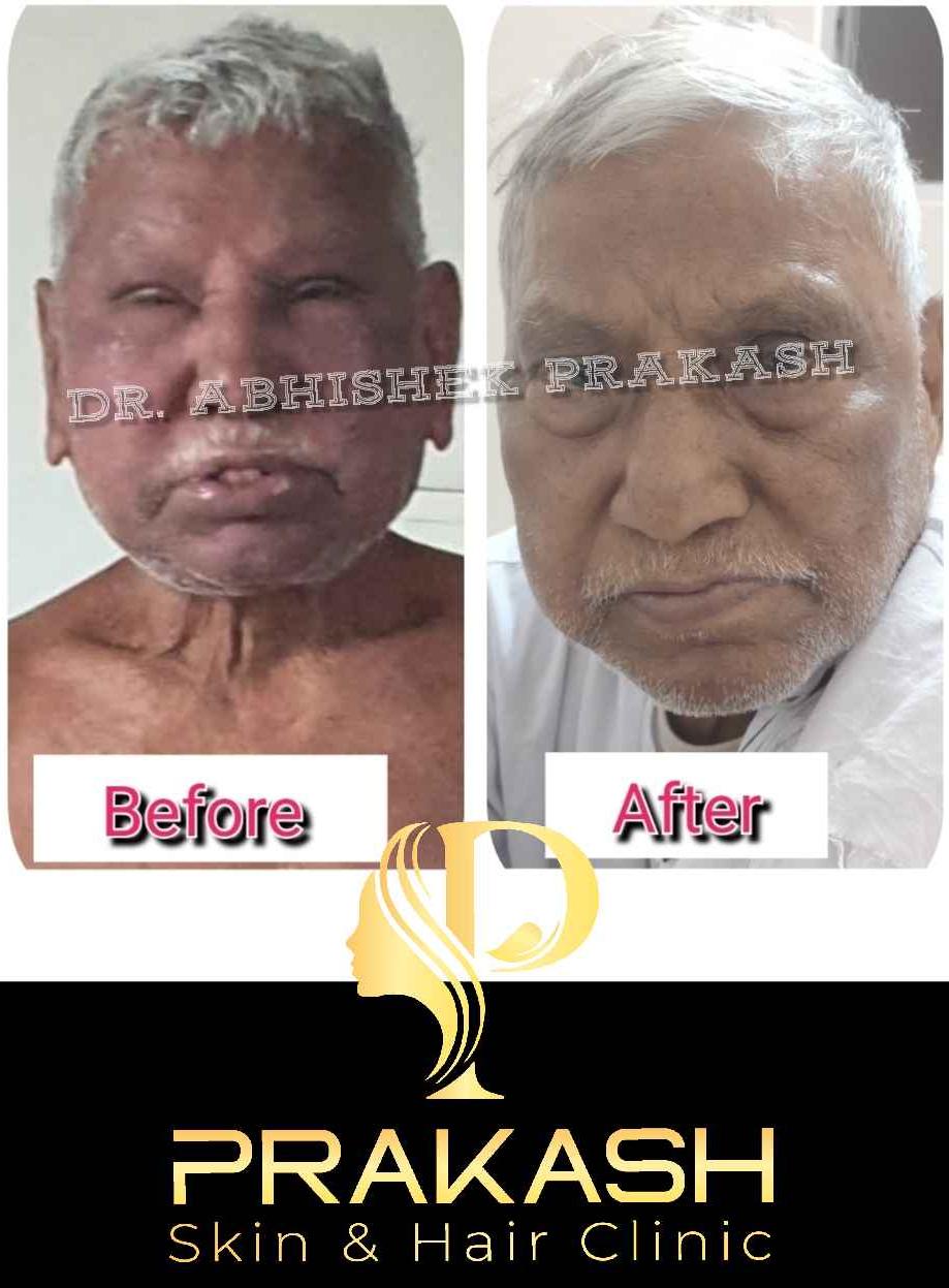 Treatment Result